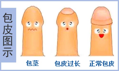 包皮过长的图片