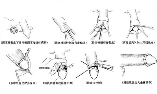 包皮手术的过程