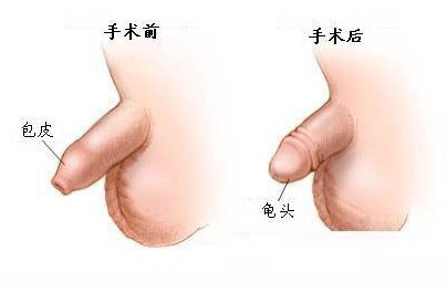 阴茎延长术