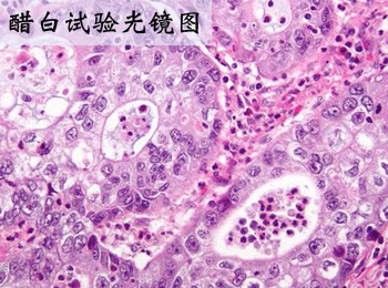 阳江专业醋白试验医院
