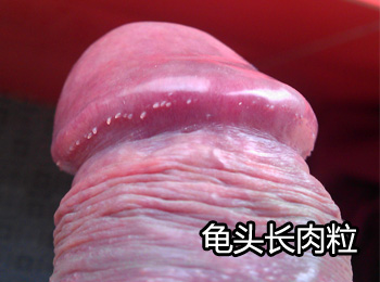 阳江专业治疗龟头长肉粒医院