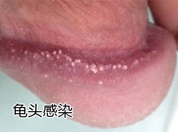 阳江专业治疗龟头感染医院
