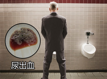 阳江专业治疗尿出血医院