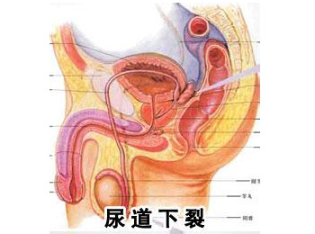 阳江专业治疗尿道下裂医院
