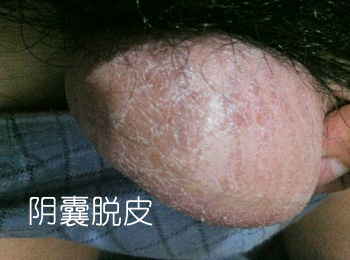 阳江专业治疗阴囊脱皮医院