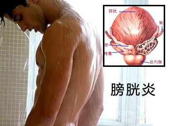 阳江专业治疗膀胱炎医院