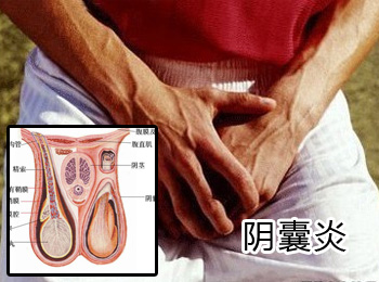 阳江专业治疗阴囊炎医院