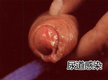 阳江专业治疗尿道感染医院