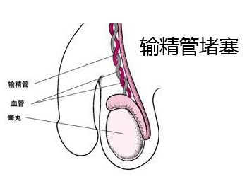 阳江专业治疗输精管堵塞医院