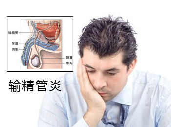 阳江专业治疗输精管炎医院