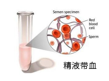 阳江专业治疗精液带血医院