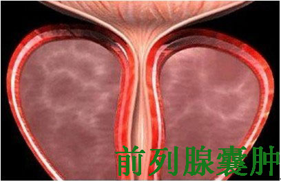 治疗前列腺囊肿要花多少钱？