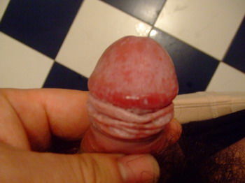 阳江男性阴茎上有疙瘩是怎么回事