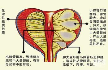前列腺痛