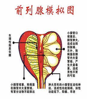 前列腺囊肿