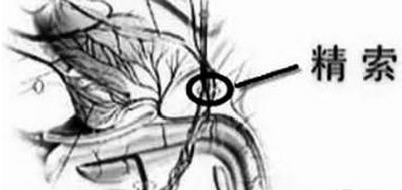 精索静脉曲张表现