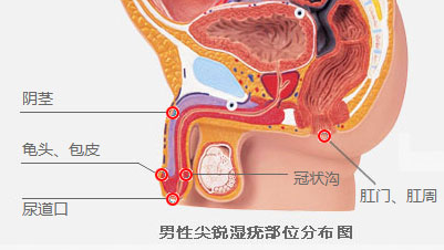 尖锐湿疣并发症