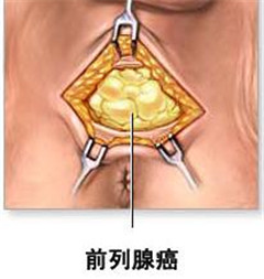 阳江前列腺癌