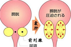 阳江患上前列腺囊肿应该如何应对更为合适