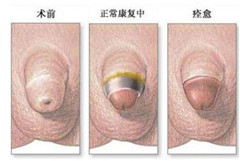 阳江男科割包皮过长多少钱