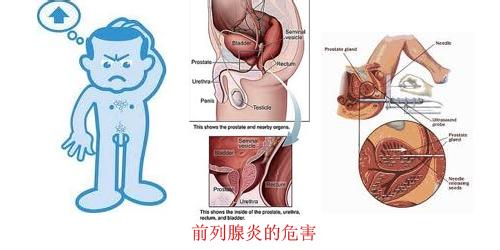 前列腺炎的危害