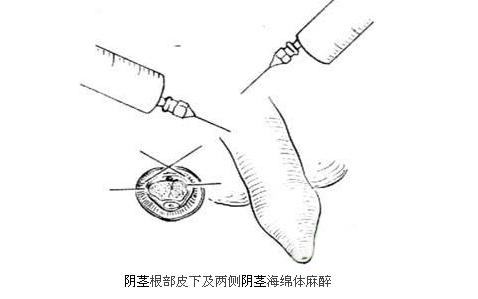 包茎的病因