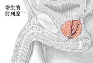 前列腺增生的治疗