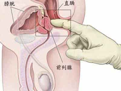 前列腺炎是怎么回事