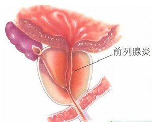急性前列腺炎的治疗有哪些?
